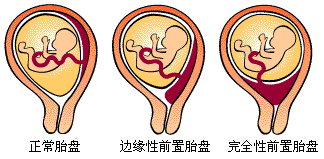 前置胎盘