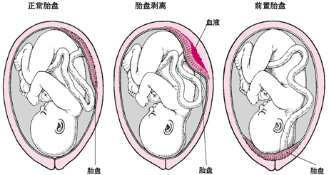 胎盘早剥