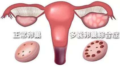 多囊卵巢综合症