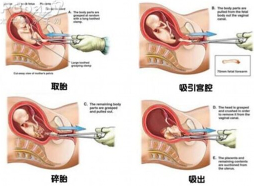 人工流产全过程(图)