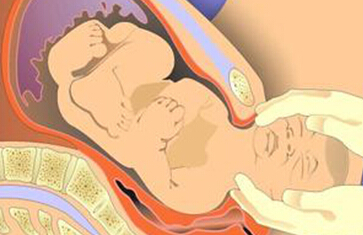难产