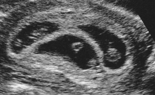 多胎妊娠B型超声检查图片