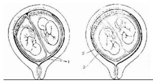 多胎妊娠多普勒超声检查图片