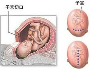 剖腹产图解