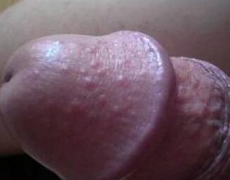 男性生殖器念珠菌感染图片