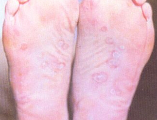 二期梅毒足部鳞屑斑