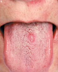 二期梅毒疹（舌头）
