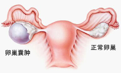 卵巢囊肿