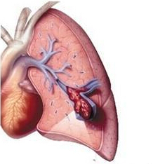 呼吸之肺血栓