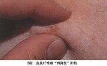 皮肤纤维瘤2.jpg