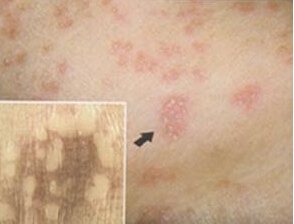 接触性皮炎9（变态反应性）
