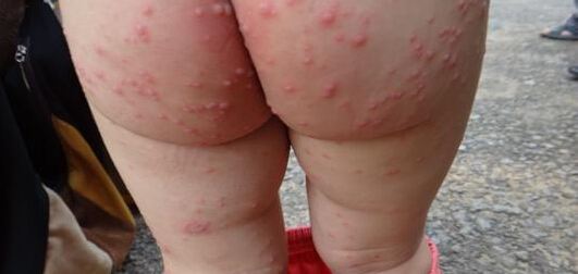 丹毒
