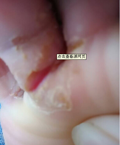 足癣(擦烂型)