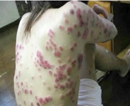 丘疹型多形红斑