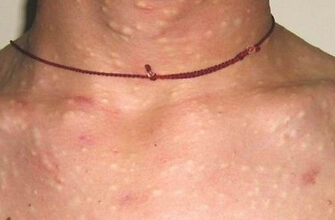 多发性脂囊瘤