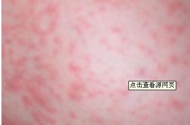 接触性皮炎8（慢性刺激性）