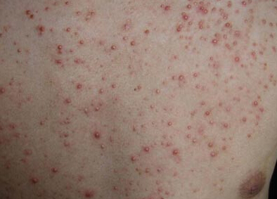 糠秕孢子菌毛囊炎