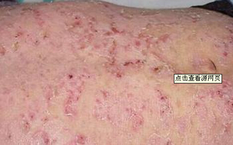 寻常型天疱疮