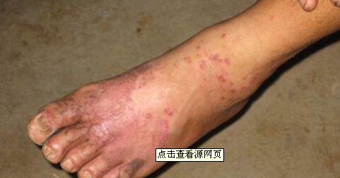 接触性皮炎3（急性原发刺激性）