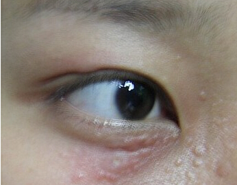 汗管瘤