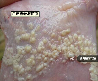 皮肤念珠菌病