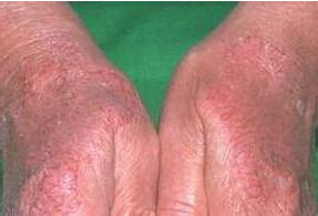 接触性皮炎4（慢性刺激性）