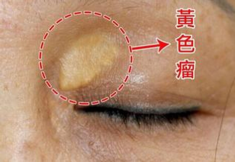 皮肤黄色瘤