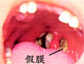 白喉