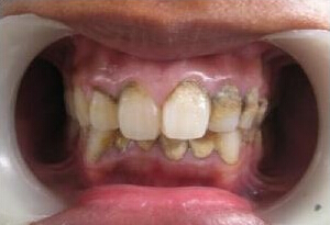 牙石