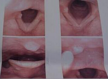 喉癌的喉镜图谱