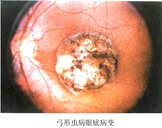弓形虫病眼底病变