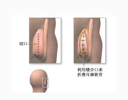 耳外科手术