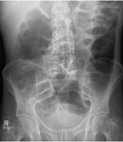 大肠的X光片