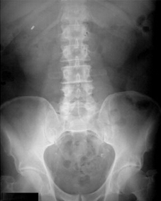小肠的X光片