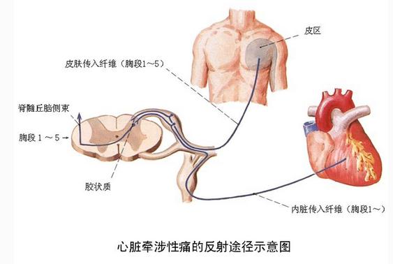 心脏牵涉性痛的反射途径示意图