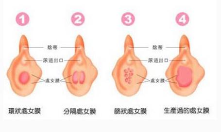 处女膜的各种形态