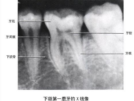 下颚第一磨牙的X线像