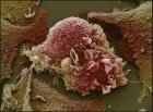 肺癌细胞这张异常的肺癌细胞图。