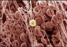 血液凝块还记得你刚刚看到的形状统一的红血球图片吗?这张图看起来像是红血球粘在了粘性网上，形成血液凝块。位于中间的那个细胞是白血球。